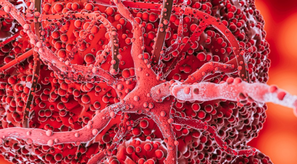 Acute Myeloid Leukemia