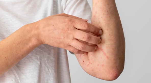 Actinic Keratosis