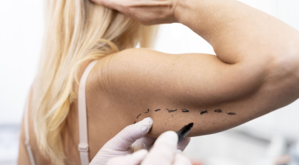 Liposuction in Turkey 2023