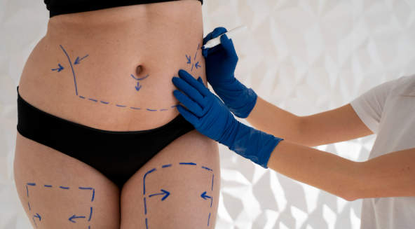 Abdominoplasty Surgery in Turkey