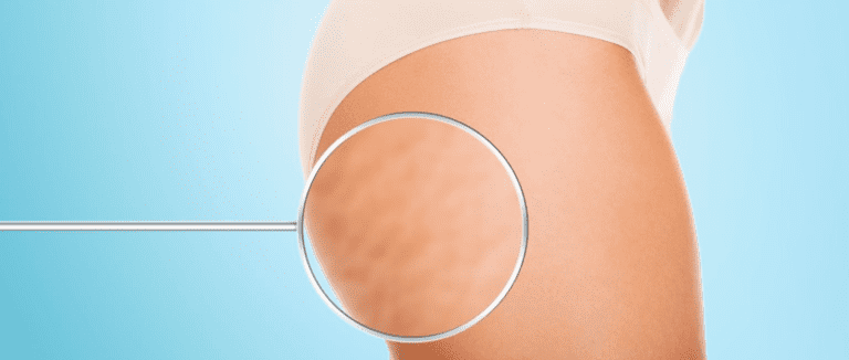Cellulitis