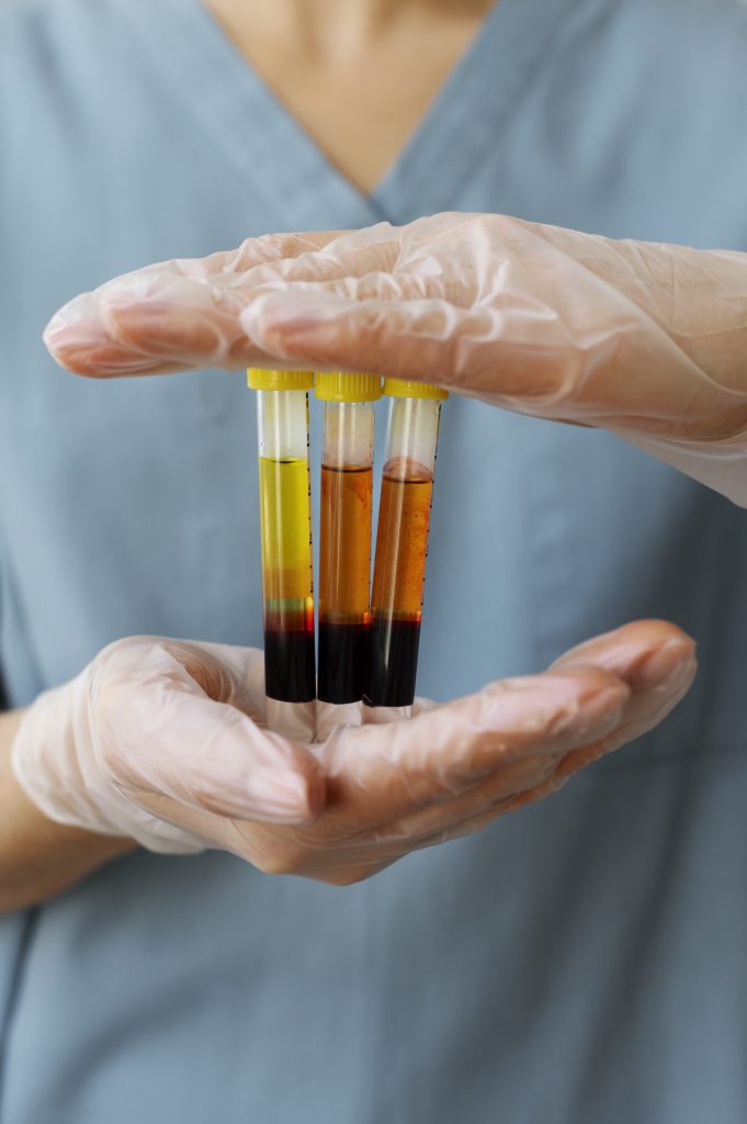 Autoimmune Disorders