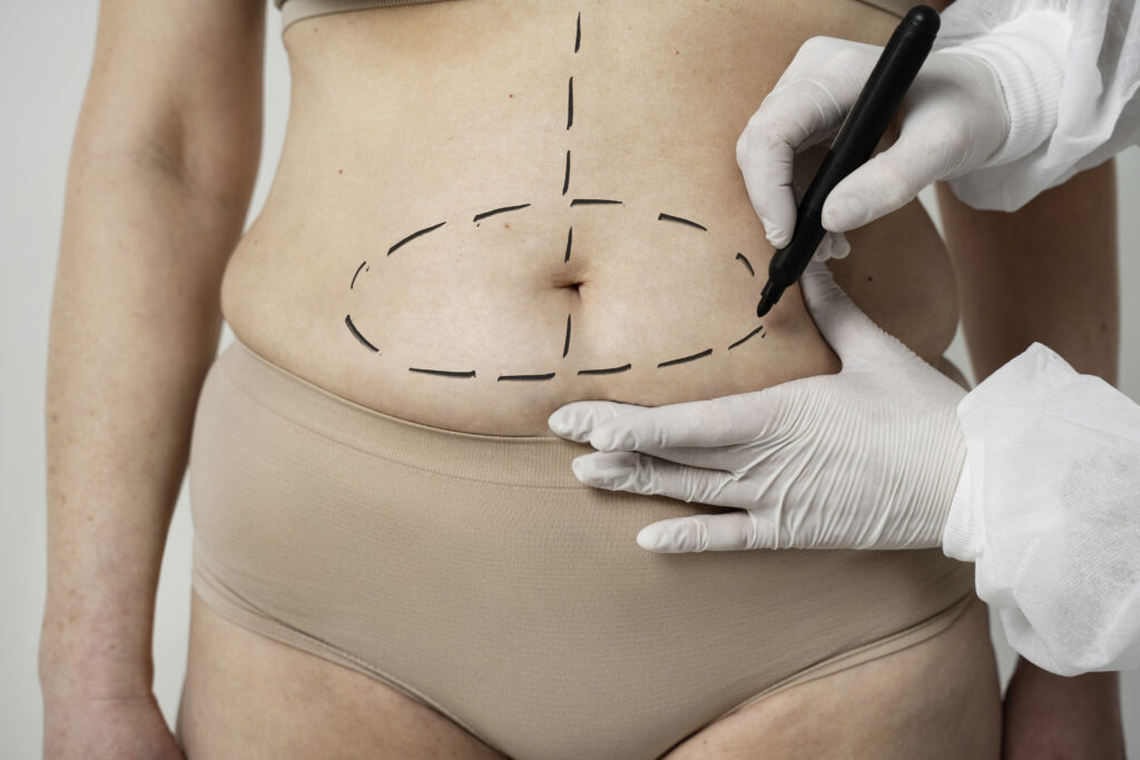 Abdominoplasty Surgery
