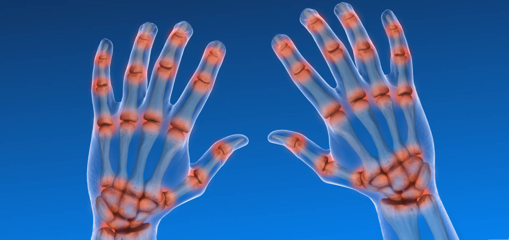 Arthritis Confirming Scan: Powerful Detection for Early Diagnosis