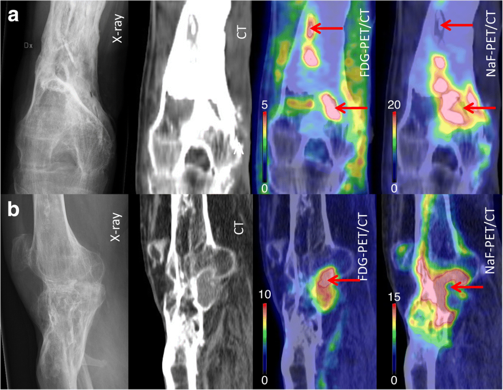 Imaging Osteomyelitis: Powerful Diagnosis for Bone Infection