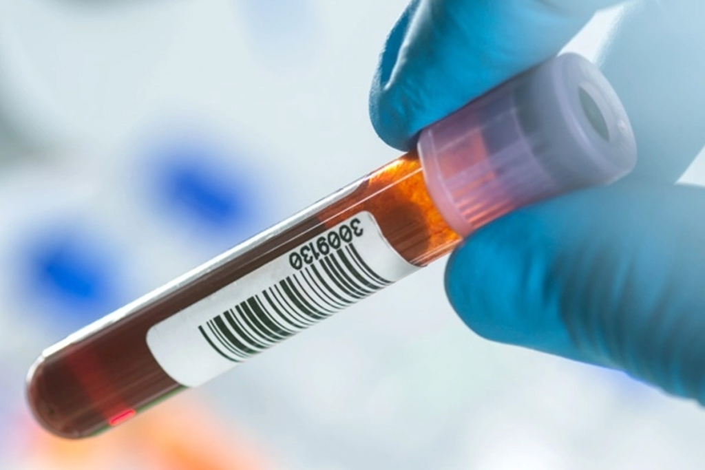 Multi-Cancer Blood Test for 50 Types: Powerful Breakthrough