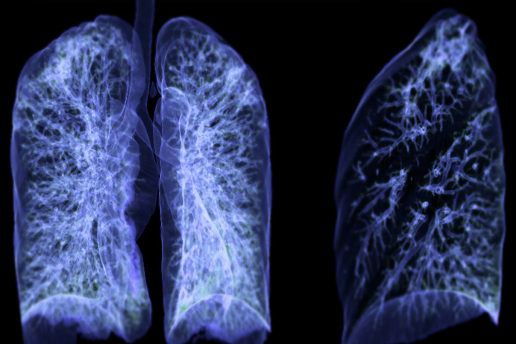 lung cancer staging imaging
