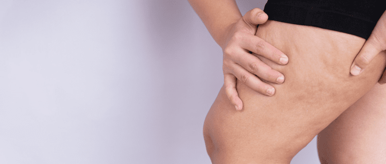 Cellulitis