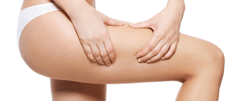 Cellulitis