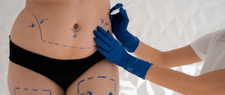 Weight Loss Surgery