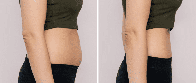 Weight Loss Surgery
