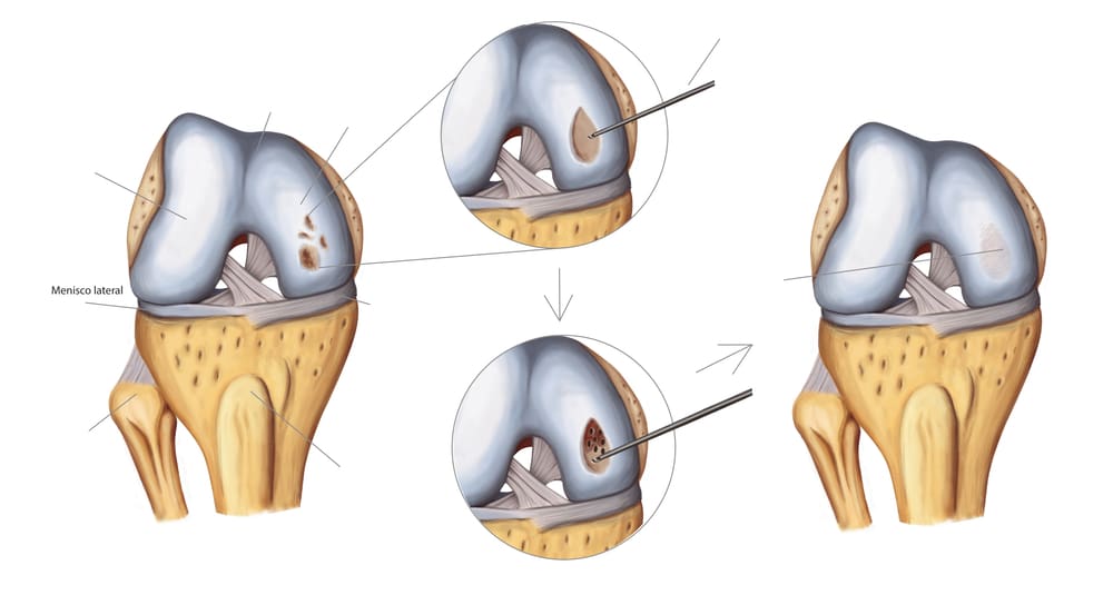 regrow knee cartilage