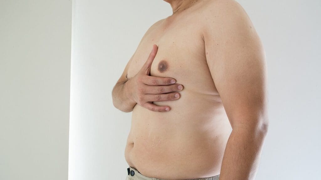 Gynecomastia