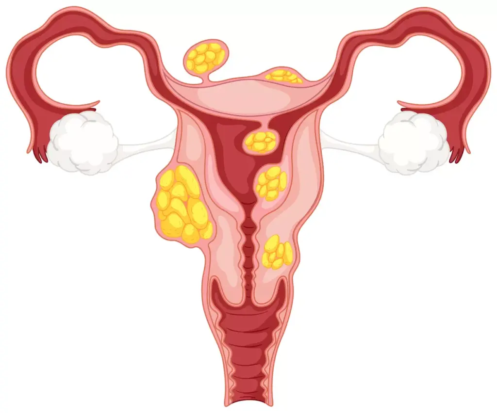 A detailed 3D illustration of a woman's uterus, prominently showcasing a cluster of uterine fibroids. The fibroids should be rendered with a realistic, textured appearance, accurately reflecting their fleshy, bulbous nature. The uterus should be depicted in a neutral, cross-sectional view, allowing the viewer to clearly see the fibroids occupying the uterine cavity. Soft, diffused lighting should create a clean, educational atmosphere, while a shallow depth of field ensures the fibroids are the focal point. The overall image should convey a sense of clinical importance, highlighting the impact these growths can have on a woman's reproductive health. A detailed 3D illustration of a woman's uterus, prominently showcasing a cluster of uterine fibroids. The fibroids should be rendered with a realistic, textured appearance, accurately reflecting their fleshy, bulbous nature. The uterus should be depicted in a neutral, cross-sectional view, allowing the viewer to clearly see the fibroids occupying the uterine cavity. Soft, diffused lighting should create a clean, educational atmosphere, while a shallow depth of field ensures the fibroids are the focal point. The overall image should convey a sense of clinical importance, highlighting the impact these growths can have on a woman's reproductive health.