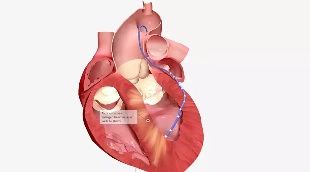 A detailed anatomical diagram showcasing the intricate structure of the atrioventricular valves within the human heart. The foreground depicts the mitral and tricuspid valves in vivid detail, capturing their delicate cusps, chordae tendineae, and papillary muscles. The middle ground reveals the surrounding cardiac chambers, including the atria and ventricles, rendered with precise anatomical accuracy. The background features a neutral, minimalist setting, allowing the viewer to focus on the valvular mechanism. The lighting is soft and diffused, highlighting the intricate textures and translucent qualities of the cardiac tissues. The overall composition is balanced and aesthetically pleasing, conveying a sense of scientific curiosity and medical understanding. A detailed anatomical diagram showcasing the intricate structure of the atrioventricular valves within the human heart. The foreground depicts the mitral and tricuspid valves in vivid detail, capturing their delicate cusps, chordae tendineae, and papillary muscles. The middle ground reveals the surrounding cardiac chambers, including the atria and ventricles, rendered with precise anatomical accuracy. The background features a neutral, minimalist setting, allowing the viewer to focus on the valvular mechanism. The lighting is soft and diffused, highlighting the intricate textures and translucent qualities of the cardiac tissues. The overall composition is balanced and aesthetically pleasing, conveying a sense of scientific curiosity and medical understanding.