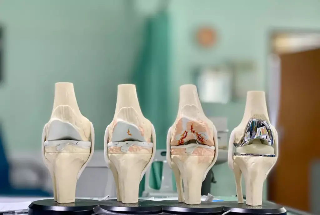 A detailed ceramic knee replacement model floating in a clean, well-lit studio environment. The replacement joint is prominently featured, showcasing its intricate design and smooth, polished surface. The background is a softly blurred, neutral gray, allowing the subject to take center stage. The lighting is diffused and evenly distributed, highlighting the component's sleek, contemporary aesthetic. The camera angle is slightly elevated, providing a clear, unobstructed view of the ceramic knee replacement and emphasizing its technical precision and medical benefits.