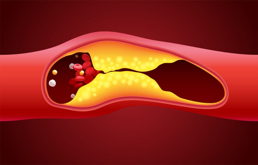 A detailed cross-section of an arteriovenous malformation A detailed cross-section of an arteriovenous malformation