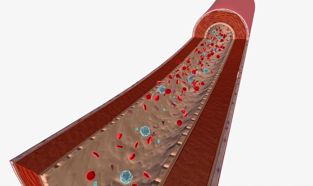 A detailed cross-section of an arteriovenous malformation structure, illustrating its complex network of tangled blood vessels and abnormal connections