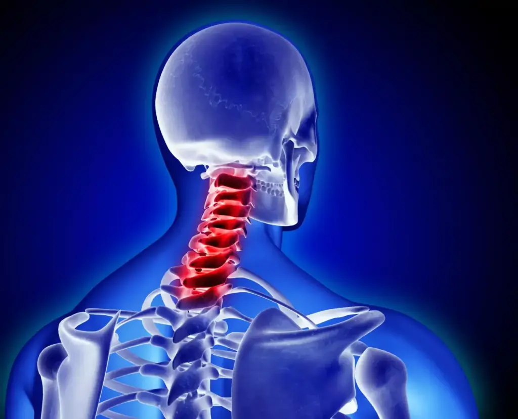 A detailed cross-section view of a cervical spine undergoing spinal fusion surgery. In the foreground, the surgeon's hands delicately manipulate surgical instruments, exposing the vertebrae and intervertebral discs. The middle ground reveals the intricate anatomy, with the spinal cord, nerve roots, and supporting structures visible. In the background, a sterile operating room setting with medical equipment and lighting casts a clinical, focused atmosphere. The image conveys the precision and complexity of this delicate neurosurgical procedure, highlighting the surgeon's expertise in restoring spinal stability and relieving neurological compression. A detailed cross-section view of a cervical spine undergoing spinal fusion surgery. In the foreground, the surgeon's hands delicately manipulate surgical instruments, exposing the vertebrae and intervertebral discs. The middle ground reveals the intricate anatomy, with the spinal cord, nerve roots, and supporting structures visible. In the background, a sterile operating room setting with medical equipment and lighting casts a clinical, focused atmosphere. The image conveys the precision and complexity of this delicate neurosurgical procedure, highlighting the surgeon's expertise in restoring spinal stability and relieving neurological compression.