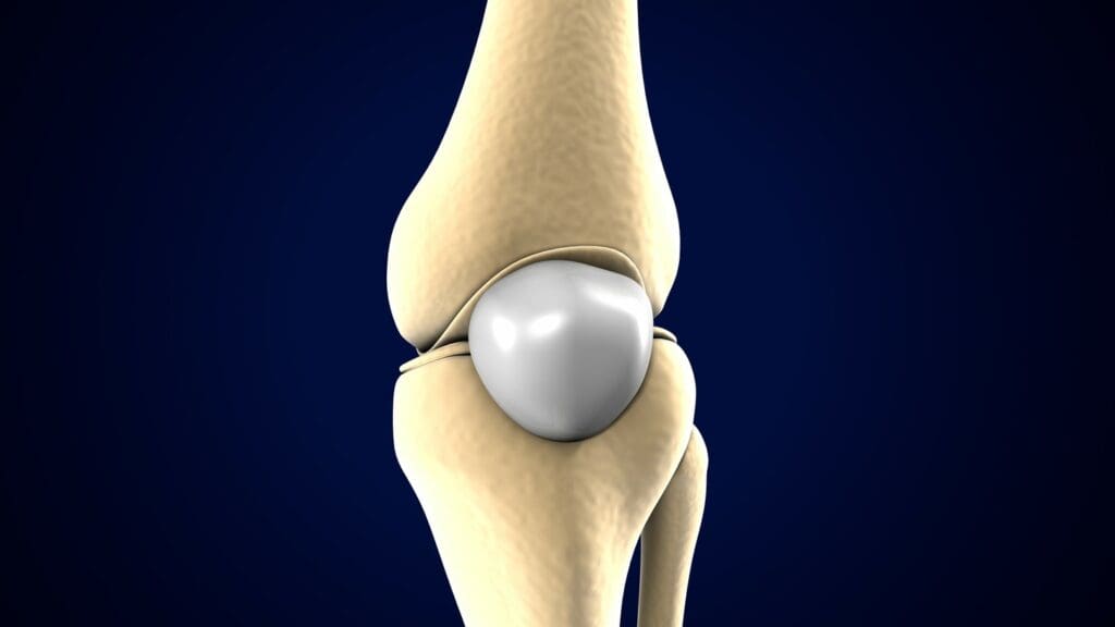 A detailed medical diagram showcasing the anatomy of a partial anterior cruciate ligament (ACL) tear. A detailed medical diagram showcasing the anatomy of a partial anterior cruciate ligament (ACL) tear.