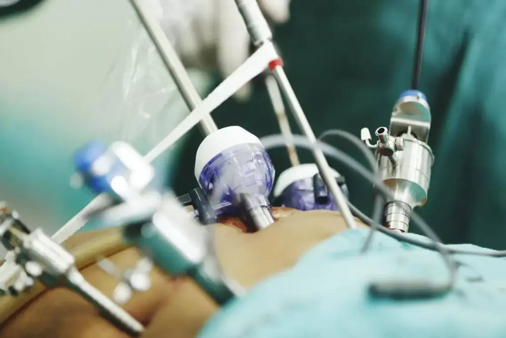 A minimally invasive heart surgery procedure taking place in a modern surgical suite. The patient's chest is open, revealing the beating heart, with the surgeon carefully manipulating tiny instruments through small incisions. The lighting is bright and sterile, creating a crisp, clinical atmosphere. The surgeon's hands are steady, their focus intense, as they work with precision to repair the heart without causing significant trauma. The scene conveys a sense of medical expertise and advanced technology working in harmony to deliver a less invasive, more patient-centric approach to cardiac care.