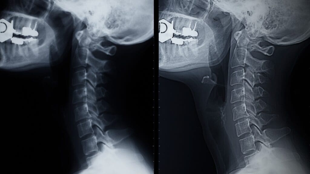 ACDF spine fusion