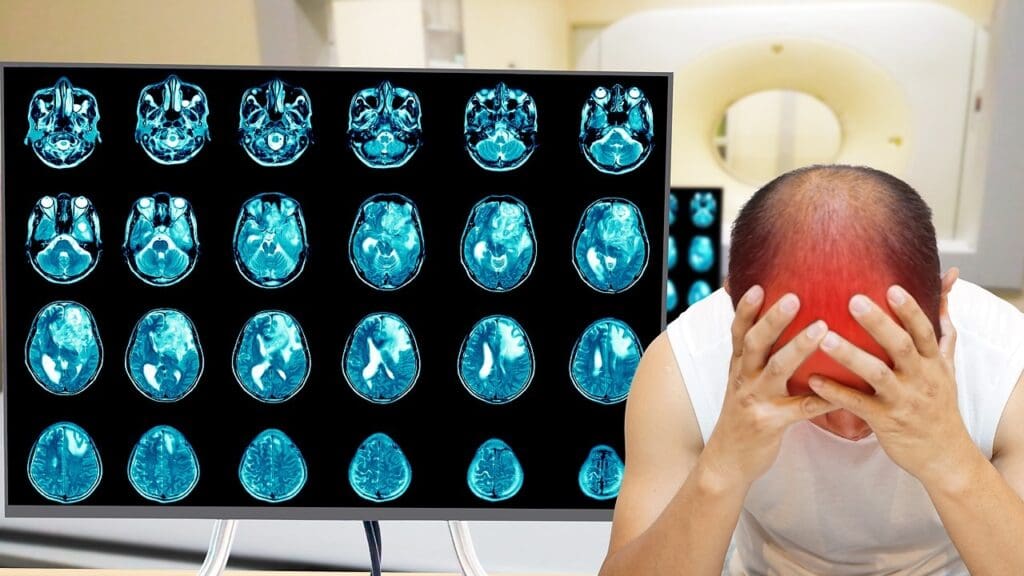 Acute Disseminated Encephalomyelitis (