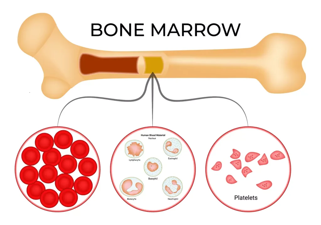 Acute Myeloid Leukemia and Bone Marrow Transplantation Acute Myeloid Leukemia and Bone Marrow Transplantation