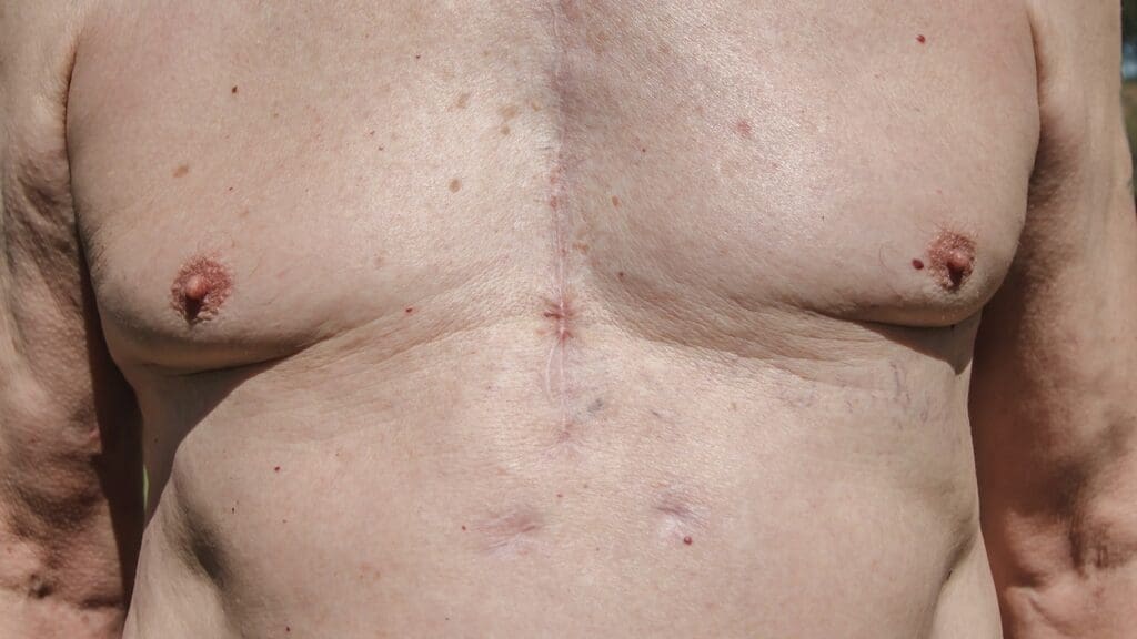 Anatomy of Heart Valve Replacement Scars Anatomy of Heart Valve Replacement Scars