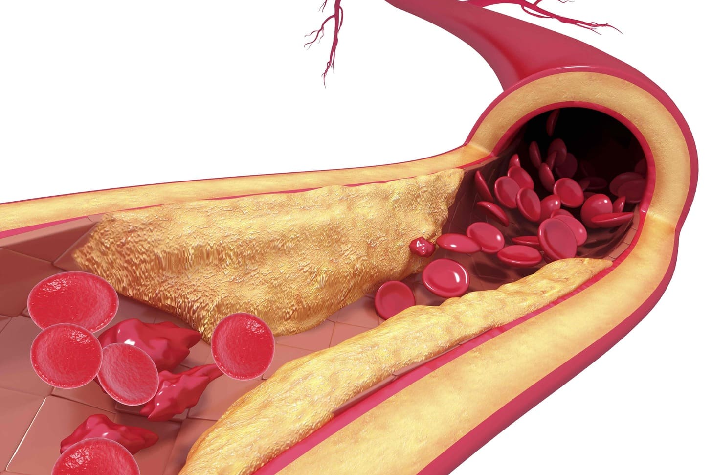 What Does AVM Stand For and Why Is Arteriovenous Malformation Dangerous?