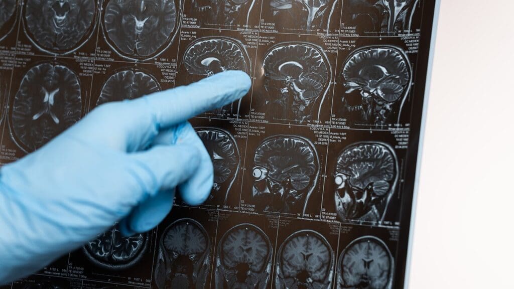 Brain Stem Anatomy Brain Stem Anatomy