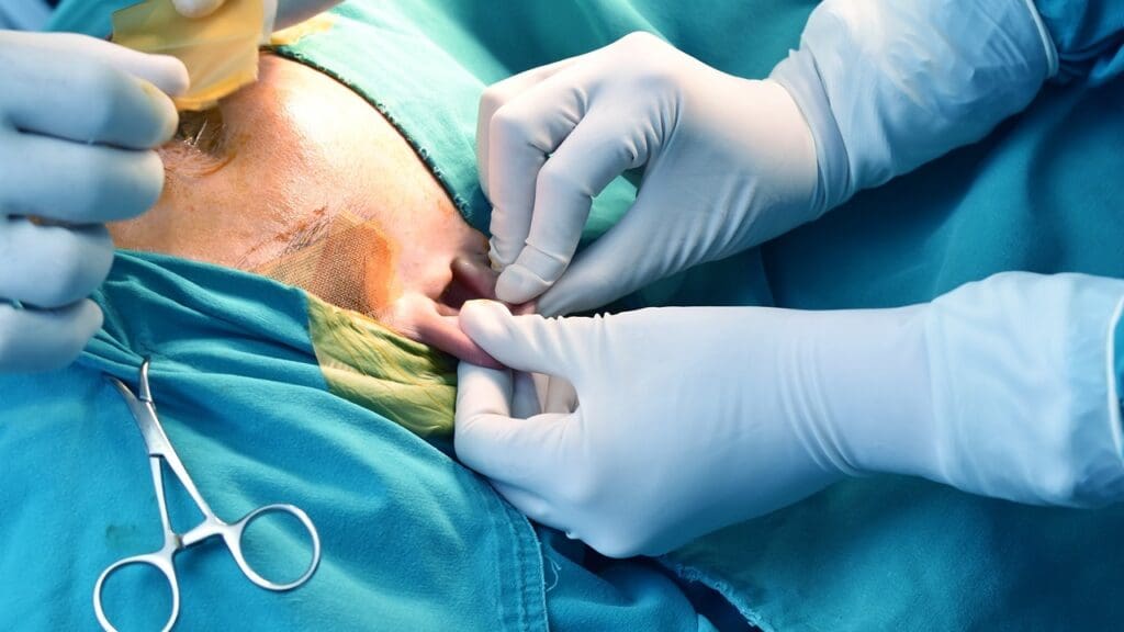 Burr Hole Surgery Recovery Time Burr Hole Surgery Recovery Time