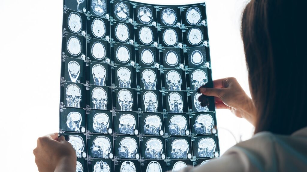 Craniotomy Recovery Process