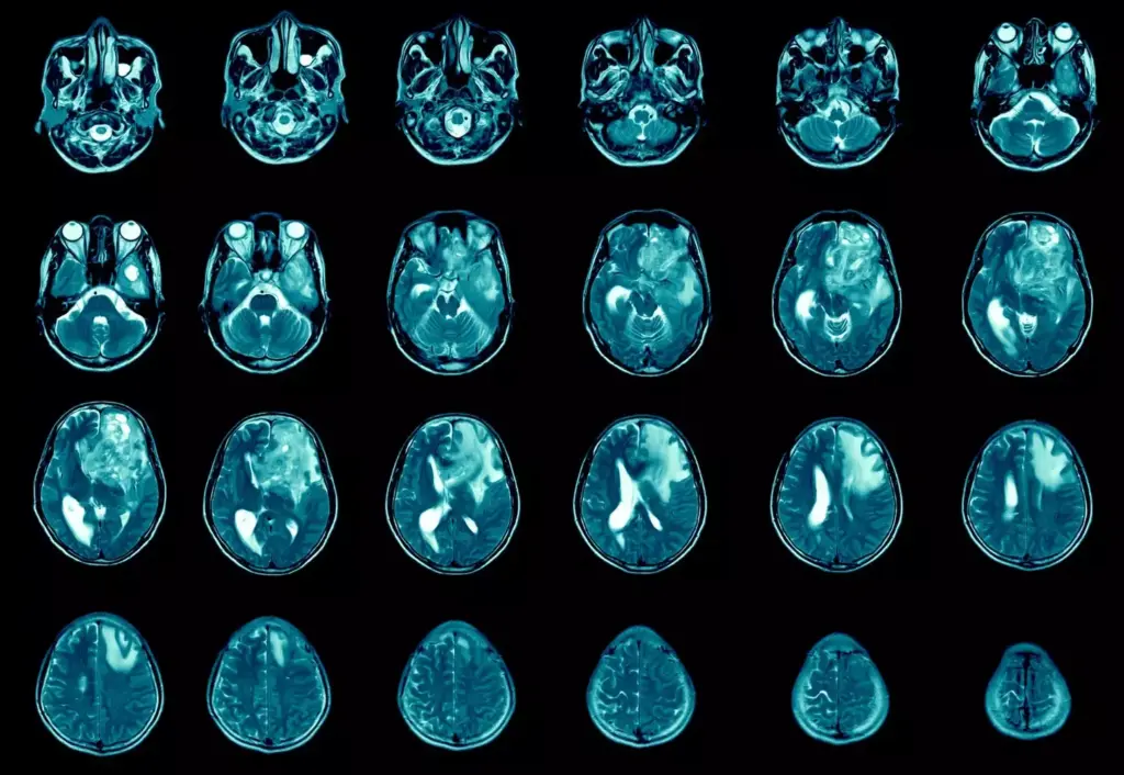 Detailed close-up diagram showcasing various types of brain tumors, including meningioma, glioblastoma, astrocytoma, and oligodendroglioma. The tumors are displayed in a stark, scientific manner against a stark white background, with each type clearly delineated and labeled with medical terminology. The lighting is bright and evenly distributed, creating a sense of clinical objectivity. The angle is orthographic, providing a clear, unobstructed view of the brain structures and tumor formations. The overall mood is one of educational clarity, designed to enhance the viewer's understanding of the different brain tumor types and their distinct characteristics.