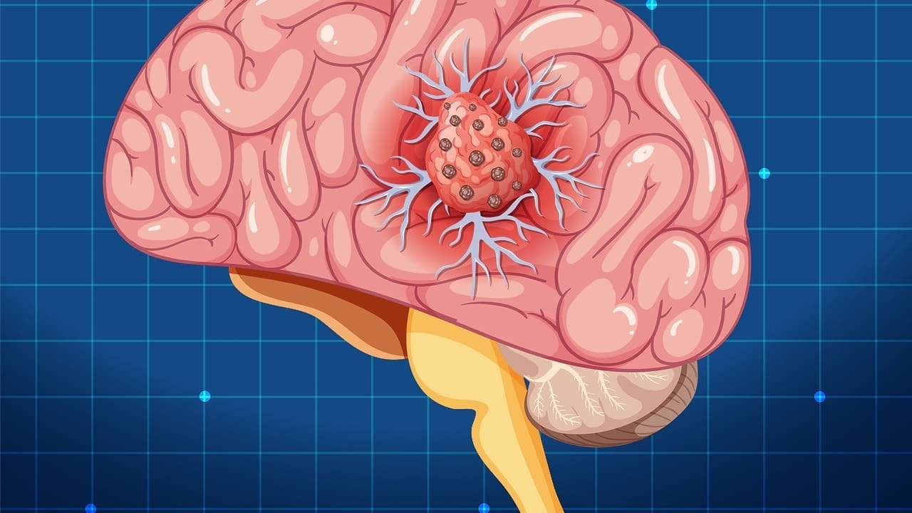 7 Key Facts About Glioblastoma Brain Stem Tumors: Symptoms, Diagnosis, and Treatment