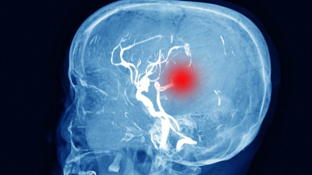 Meningioma Tumor Locations Meningioma Tumor Locations