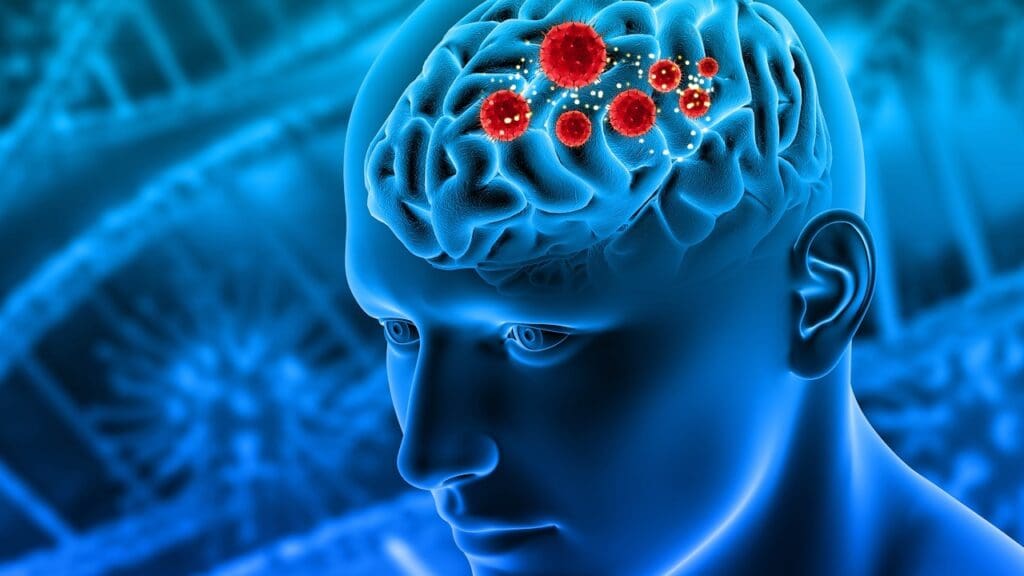 Meningioma Tumor Locations Meningioma Tumor Locations