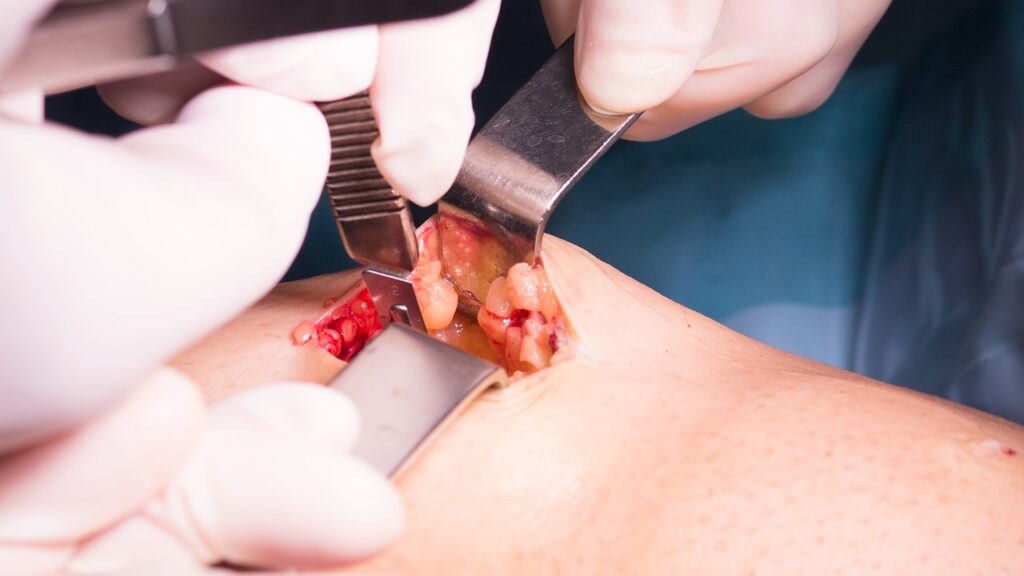 Mohs Surgery for Basal Cell Carcinoma Mohs Surgery for Basal Cell Carcinoma