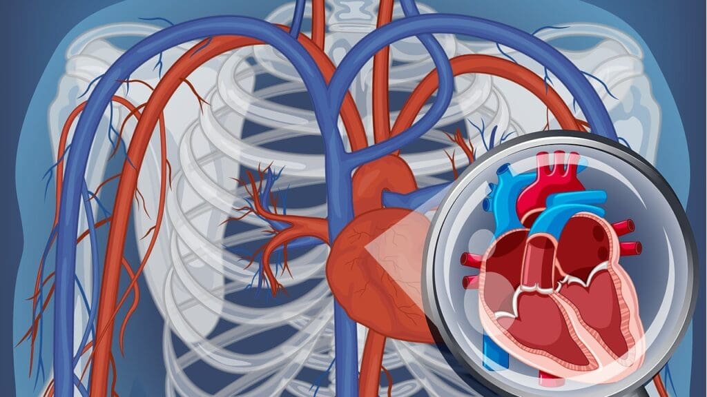 Right Sided Aortic Arch with Vascular Ring