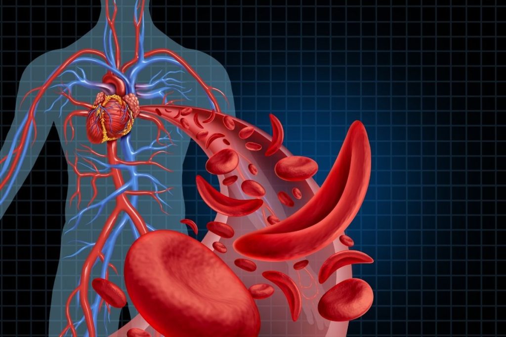 Sickle Cell Anemia Treatment: Breakthrough Cure Insights