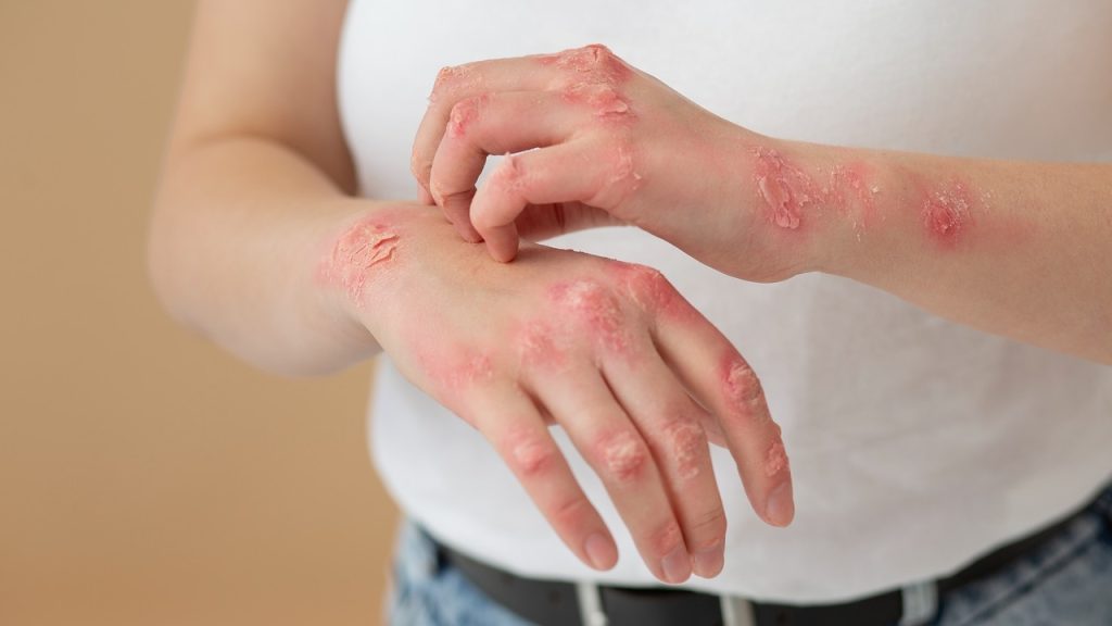Skin Rash and Redness  in GVHD Skin Rash and Redness  in GVHD