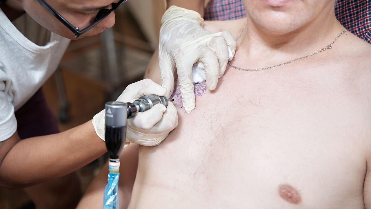 How to Remove Skin Cancer: Step-by-Step Guide to Basal and Squamous Cell Carcinoma Surgery and Excision