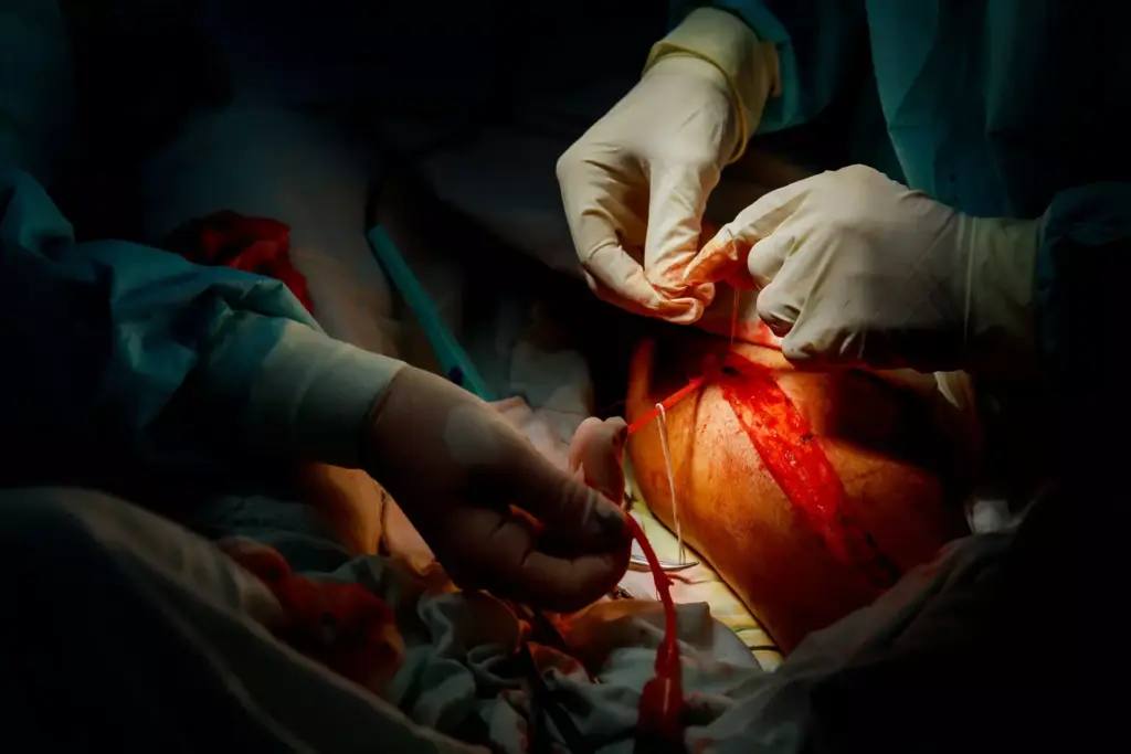 Understanding Quadruple Heart Bypass Surgery