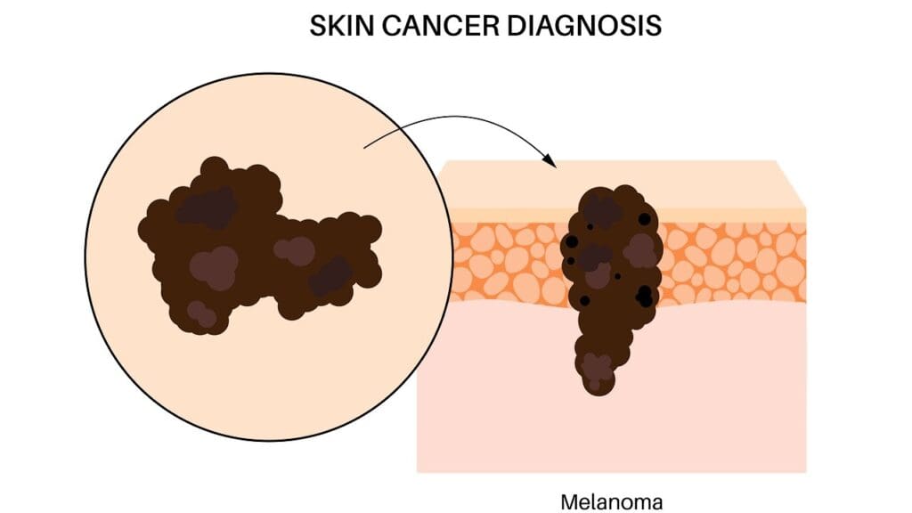 Understanding Skin Cancer