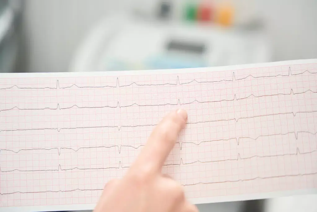What Is Atrial Flutter What Is Atrial Flutter