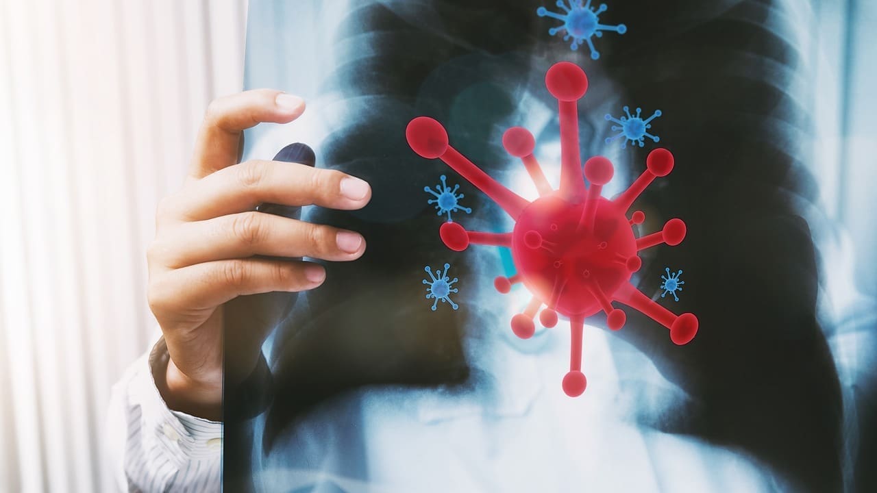 What Is Chronic Graft-Versus-Host Disease and How Is It Managed After Bone Marrow Transpla