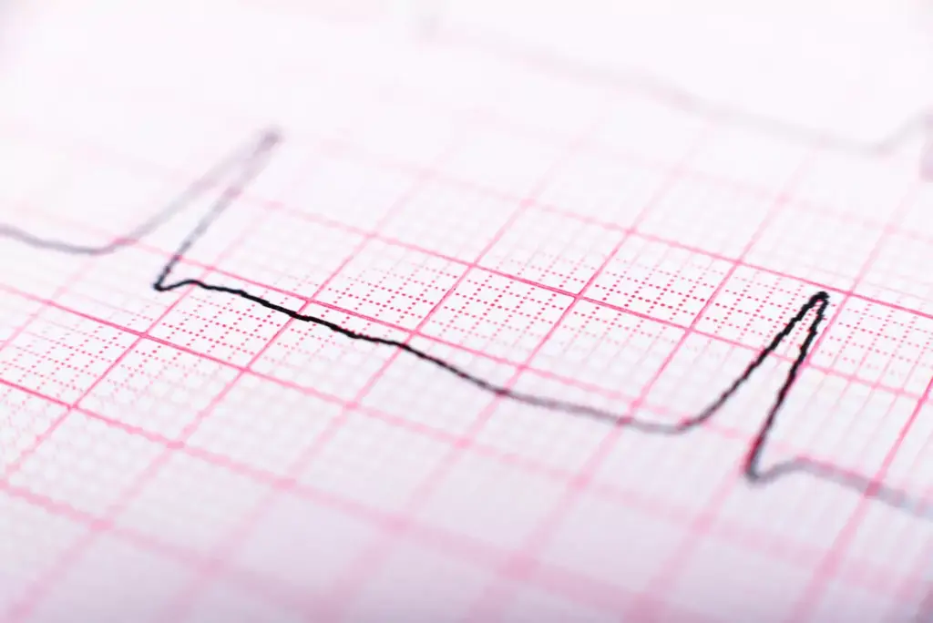 What Is Irregular Sinus Rhythm? What Is Irregular Sinus Rhythm?