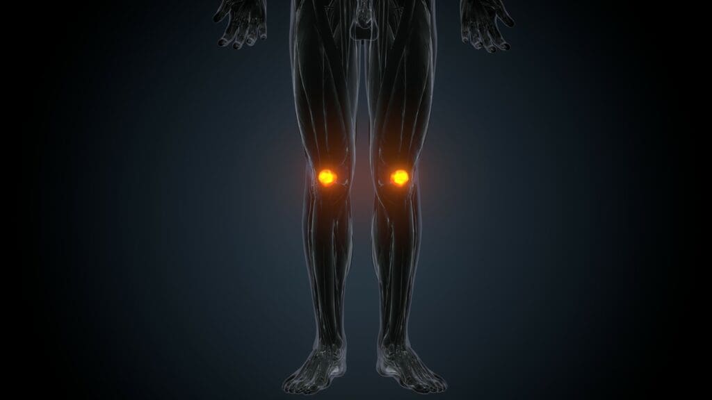 a partially replaced human knee joint,