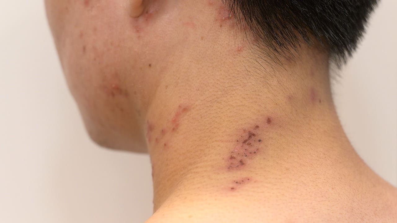 How to Care for and Minimize Your ACDF Surgery Scar: Expert Step-by-Step Guide