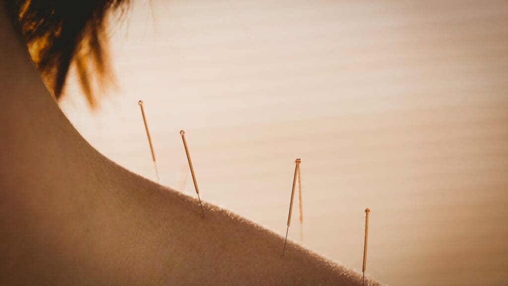 acupuncture acupuncture
